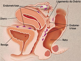 Classificações de endometriose